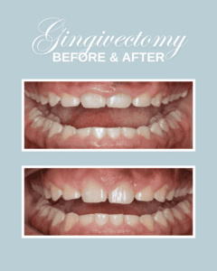 Laser Contouring before & after (23)