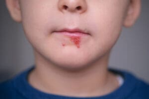 cold sore canker sore treatment in Woodlands TX