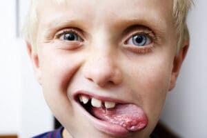 tongue-ties treatment in Woodlands, TX