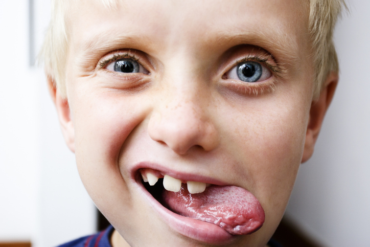 tongue-ties treatment in Woodlands, TX