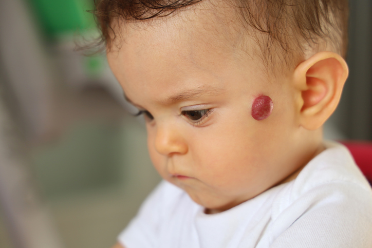 What Is a Fibroma or Hemangioma? How Laser Dentistry Can Remove Oral Growths